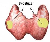 Multiple Nodules Patients with multiple nodules should receive the same evaluation as