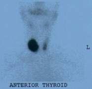 Nodules with a Suppressed TSH Autonomy must be ruled out with a thyroid nuclear scan