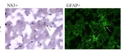 (astrocytes) Positive and negative-strand HCV RNA detected in laser capture microdissected