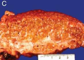 Normal liver Cirrhosis Poynard T, et al. Lancet.1997;349:825-832. Monto A, et al. Hepatology. 2002;36:729-736.