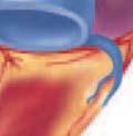 interventricular sulcus with