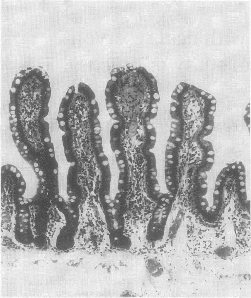 602 Fig 1 Biopsy ofnormal small intestinal mucosa from reservoir. Shepherd, Jass, Duval, Moskowitz, Nicholls, Morson -i.. -:. -.:, 1-7 - ".