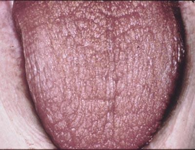 Xerostomia: dry mouth May be caused by: absence or diminished quantity of saliva Medications