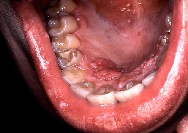 HPV: Human Papillomavirus We know of 40 different HPV viruses all of which can infect the mouth and throat.