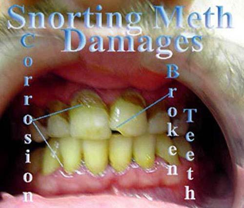 Meth mouth is an informal name for advanced tooth decay attributed to heavy methamphetamine