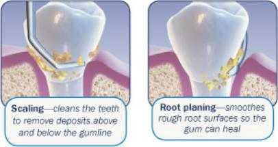 Periodontal treatments: Debridement/Scaling and Root planing Oral medications including