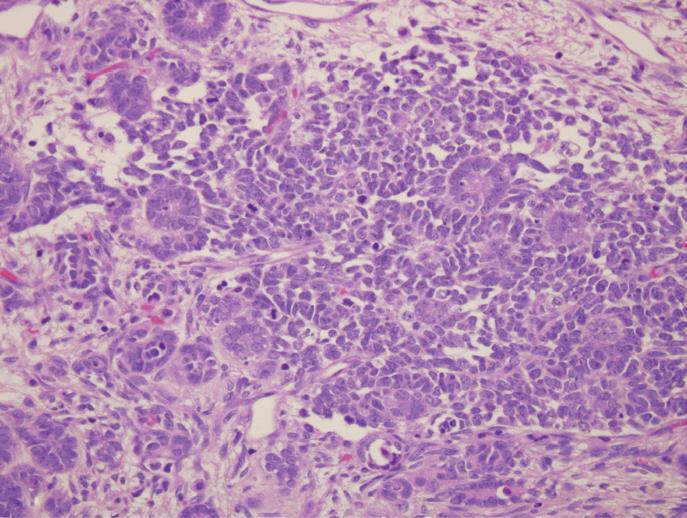 Triphasic combination Wilms tumor, morphology large, solitary, well-circumscribed mass 10% are either bilateral or multicentric at the time of diagnosis Soft, homogeneous, and tan to gray, with