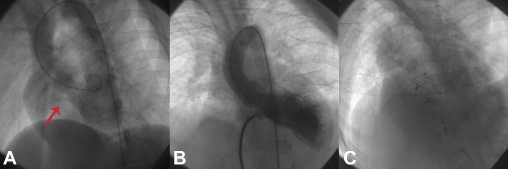 (B) Ascending aortic angiography was performed again to verify complete occlusion, new-onset aortic valve regurgitation, and residual shunts. (C) Simultaneous atrial septal defect occlusion.