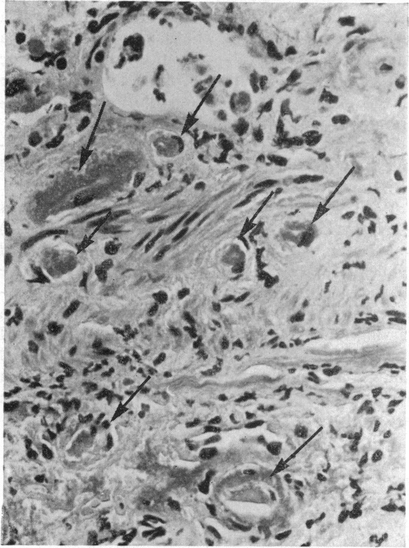 486 3. Fibrin microthrombi were identified in capillaries in all five biopsies.