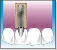 10 MAKING YOUR NEW TEETH Dr. Moffitt begins making your prosthesis when your gums have healed around the abutments, usually two to four weeks after surgery.