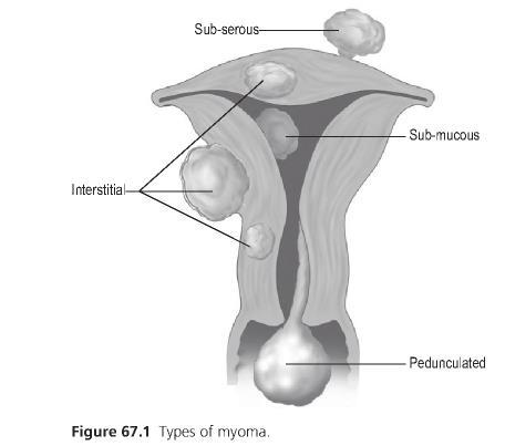 Types of myoma