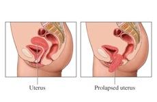 Prolapse of the Uterus despite the many anchoring ligaments, the principal support of the uterus is provided by the muscles of the pelvic floor, namely the muscles of the urogenital and pelvic