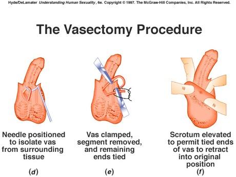 Vasectomy office surgical procedure, where the doctor makes a small incision or puncture into the scrotum, pulls out a loop of the vas deferens, cuts it, ligates (ties) off the ends and cauterizes