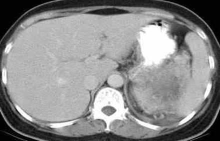 CT post-enhanced the interfaces between the posterior gastric walls, pancreatic tail, splenic hilum and the