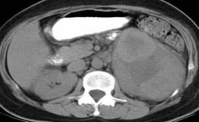 CT pre-enhanced enhanced The possibility of renal lymphoma or