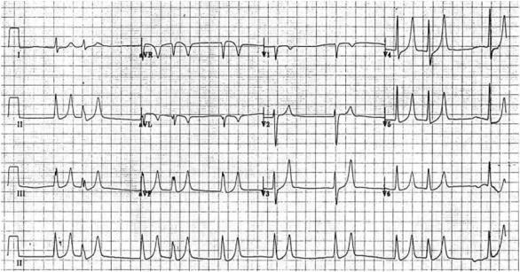 ST changes (which may mimic myocardial