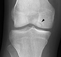 Deep Knee Pain That Does Not Hurt with Palpation with Mechanical Sensations Avascular necrosis of the