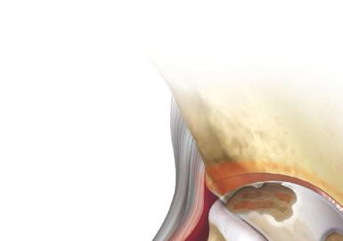 An artificial joint (prosthesis) can help relieve pain and restore