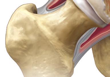 Problem Hip Roughened bone Worn cartilage Inflammation Artificial Hip