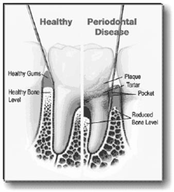 How Periodontal Disease occurs Nutrition & Perio Disease Also called gingivitis, pyorrhea Plaque bacteria infect gums Gums recede Bacteria infect