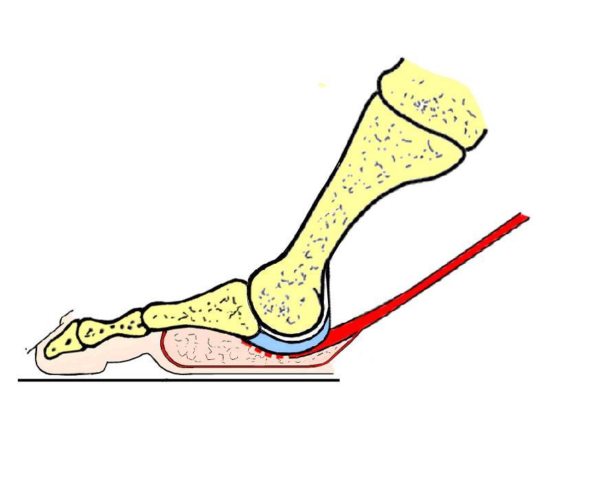 HIGH HEEL ELEVATION Changing shape of the foot driven by plantar aponeurosis and tibialis posterior Heel, ankle, talonavicular joint and forefoot centre of load kept