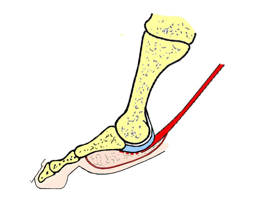 LIFT OFF Plantar pad loses ground contact Energy stored in stretched plantar aponeurosis released flexing