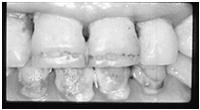 resistance to oral infections Ultimately may result in increased tooth loss Overnutrition