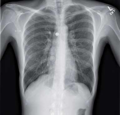 Figure 5. Digital radiograph with noted lesions (sarcoma). 5 IQQA-Chest supports clinicians in identification, quantification, evaluation and reporting of pulmonary nodules.