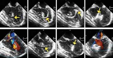 Percutaneous Device Closure of Congenital VSDs Current techniques and results for treating ventricular septal defects. BY KARIM A. DIAB, MD; QI-LING CAO, MD; AND ZIYAD M.