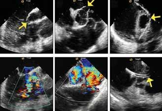 A C E G I K B D F H J L Figure 2. Intracardiac echocardiographic images guiding PmVSD closure in a 55-year-old woman with an 11-mm X 12.