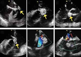 Short-axis views without (C) and with (D) color Doppler demonstrating the VSD with left to right shunt (arrow).