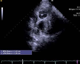 hours (intermittent) Echo parameter: color Doppler showed increased pulmonary blood flow to the LA, dilation of