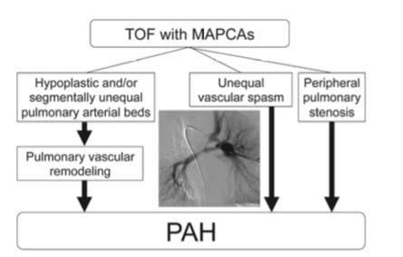 TETRALOGY OF FALLOT Pulmonary hypertension due to MAPCAs Heart failure due to secondary cardiomyopathy that results from RV pressure