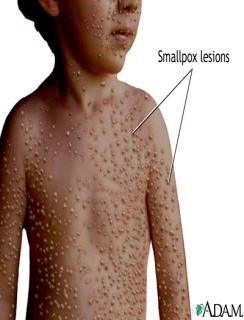 Ex. Smallpox No