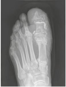 STIMULAN can transform outcomes in infected non-unions, osteomyelitis and periprosthetic joint infection 4 6 TRANSFORMS OSTEOMYELITIS IN DIABETIC FOOT 4 Patient presented with: persistent