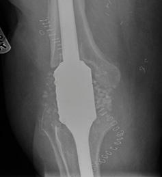 TRANSFORM INFECTED TRAUMA 5 Patient presented with: infected femoral nail and non-union of left femur with persistent discharging wounds proximally and distally.