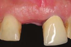 at tooth 15 after apicectomia OPG 6 months after