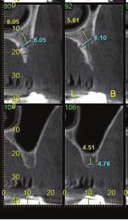 An adequate bone formation around the implants following the procedure is