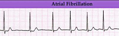 Atrial Fibrillation This is a result of many sites within the atria firing electrical impulses in an