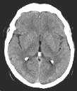 CT Results Negative CT Scan of Head