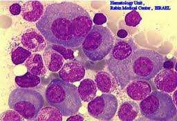 MGUS/Multiple Myeloma (cont.) Bone Marrow Aspirate MGUS/Multiple Myeloma (cont.) Flow cytometry: Small (0.