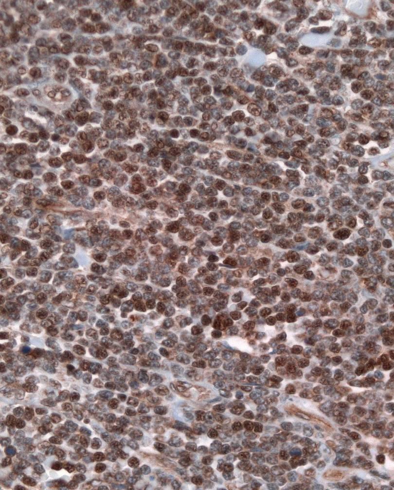 Sox 11 expression in Mantle cell lymphoma Most MCL