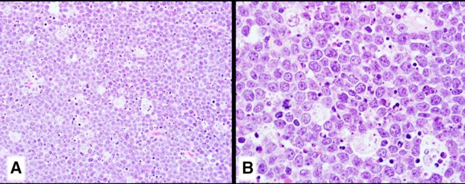 MICROSCOPIC FEATURES ~50% have morphology of Burkitt Lymphoma or intermediate between DLBCL and BL Medium-size to large cells with large nuclei, monomorphic and with