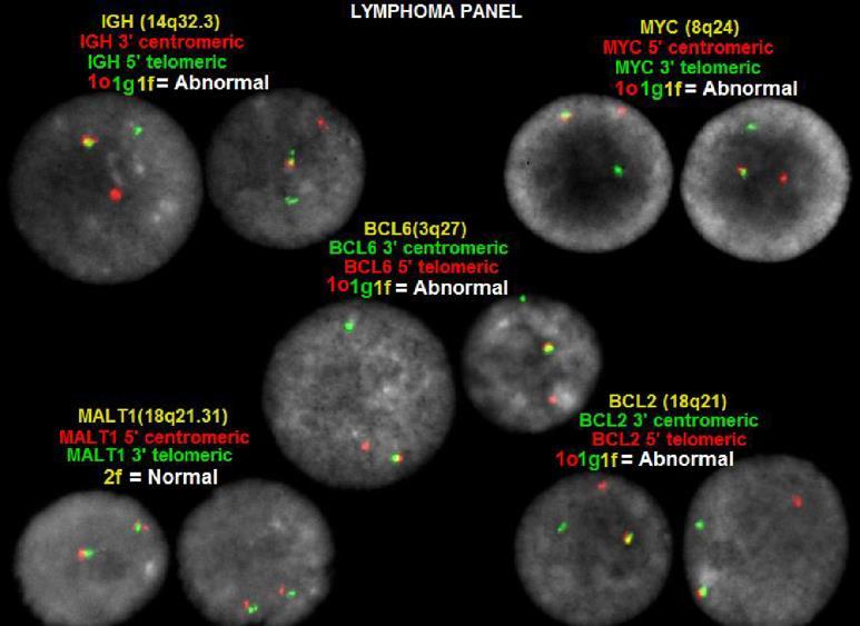 HIGH GRADE B-CELL LYMPHOMA (HGBCL) WITH MYC AND BCL2 AND/OR BCL6 REARRANGEMENTS nuc ish (BCL6x2)(3 BCL6 sep 5 BCL6x1)[198/200],
