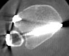 clamps Fluoroscopy Beware posterior