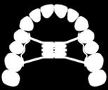 rapid palatal by means of fixed appliances. Screw body: 14.4 mm / maximum : 12.