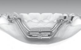 The bands can be connected by means of a remaloy wire ø 1,0 mm (REF 528-100-00) either on the palatal or the buccal side as a means of reinforcement.