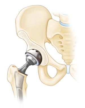 In total hip replacement, both the head of the femur and the socket are replaced with an artificial device. Complications. Although complications are possible with any surgery, Mr.