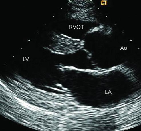 in the absence of diastolic dysfunction Mitral