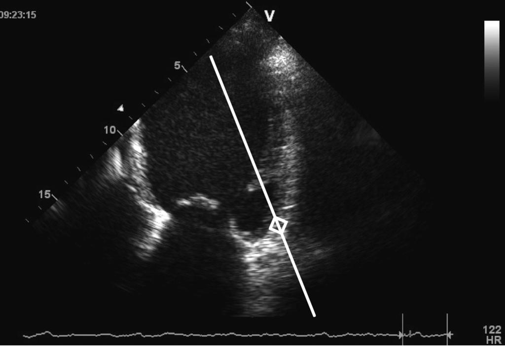 Faggiano et al A B Fig. 6 - Correlation between mitral E/Em ratio on tissue Doppler of mitral annulus and left ventricular filling pressure (modified from Nagueh et al (8)). See the text for details.
